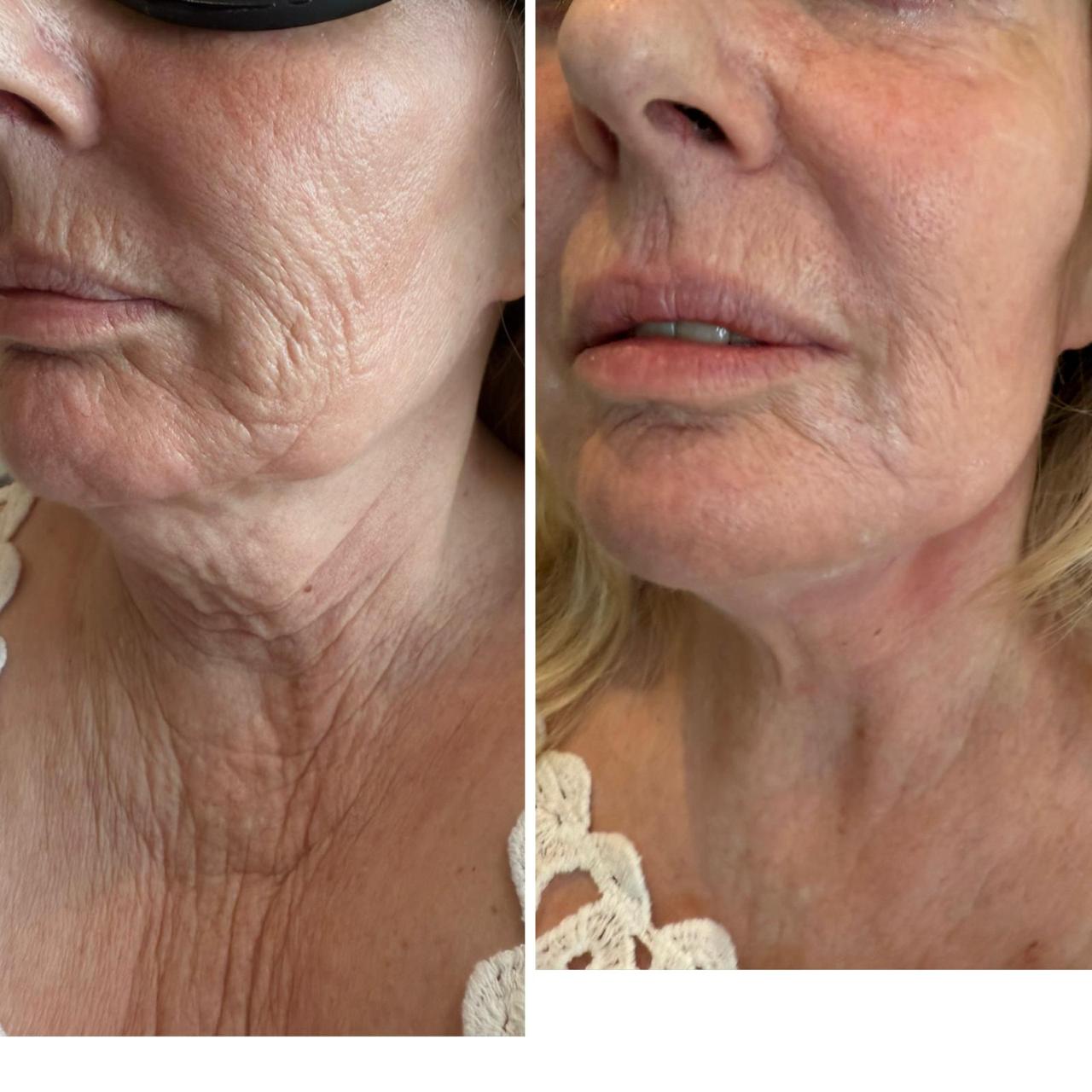 Endolift before and after at Dr Ram Aesthetics — lower face and jawline tightening
