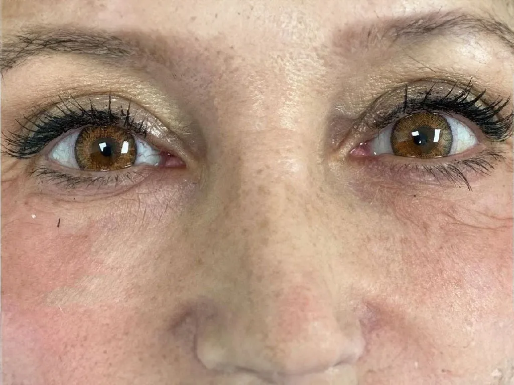 Lower Eyelid after genuine Endolift treatment — official Endolift gallery