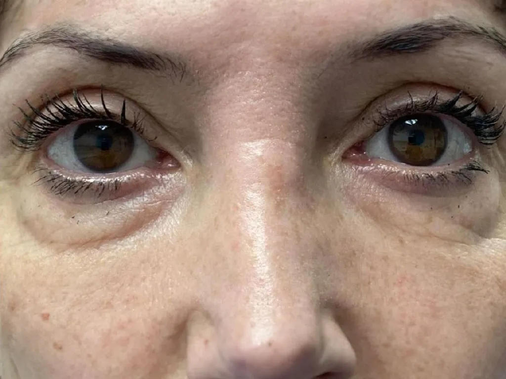 Lower Eyelid before genuine Endolift treatment — official Endolift gallery