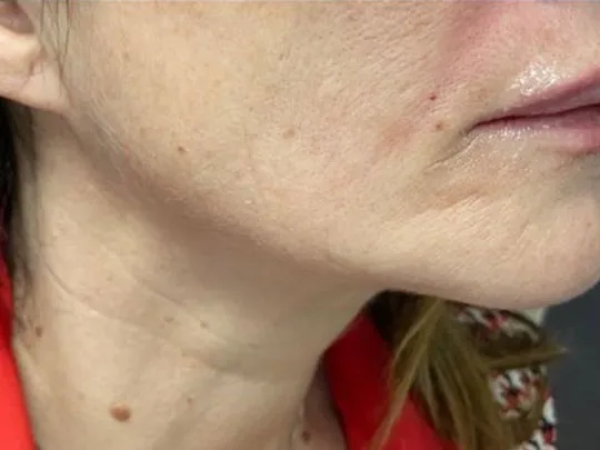 Jawline after genuine Endolift treatment — official Endolift gallery