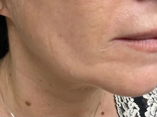 Jawline before genuine Endolift treatment — official Endolift gallery