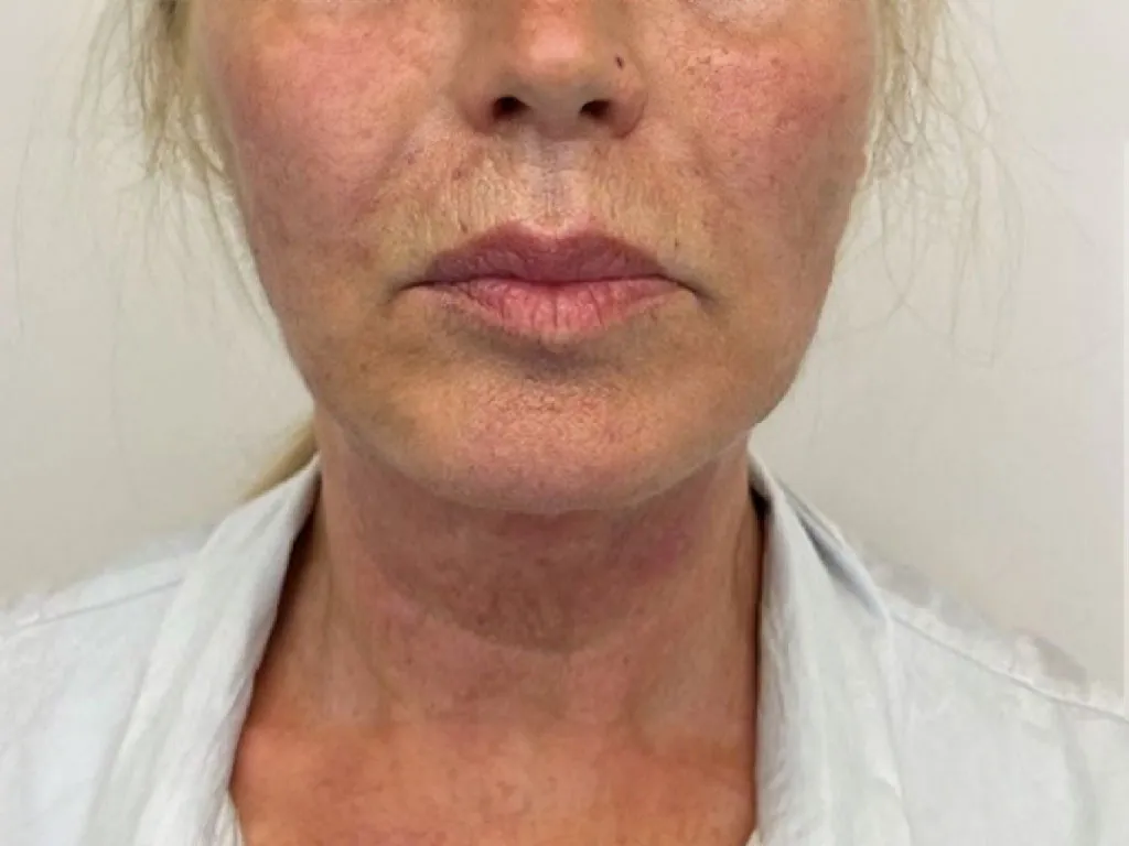 Neck after genuine Endolift treatment — official Endolift gallery