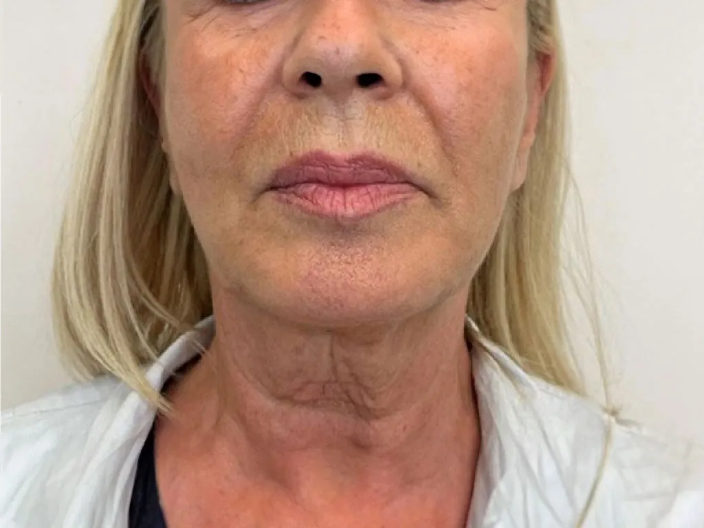 Neck before genuine Endolift treatment — official Endolift gallery