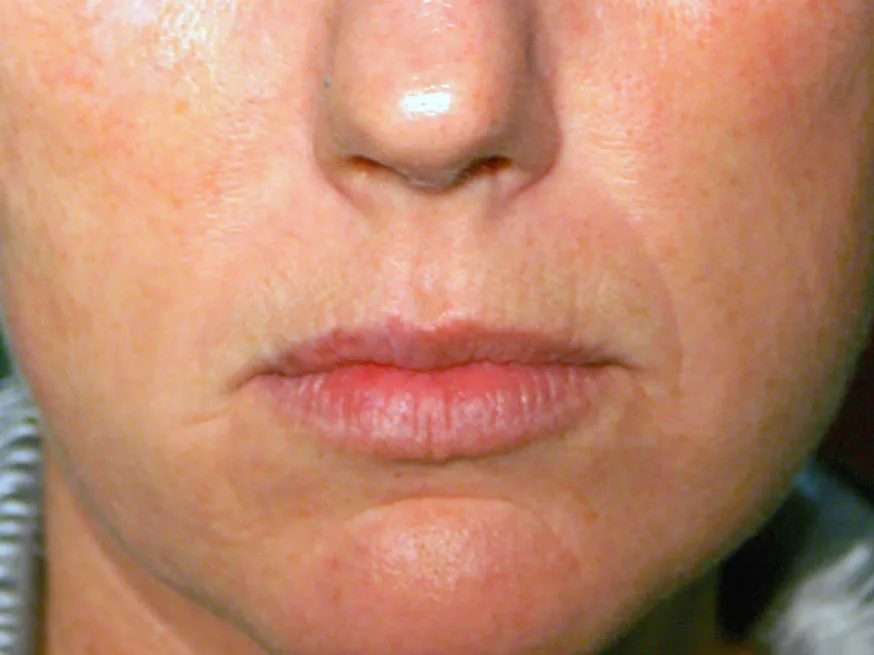 Skin Texture after genuine Endolift treatment — official Endolift gallery