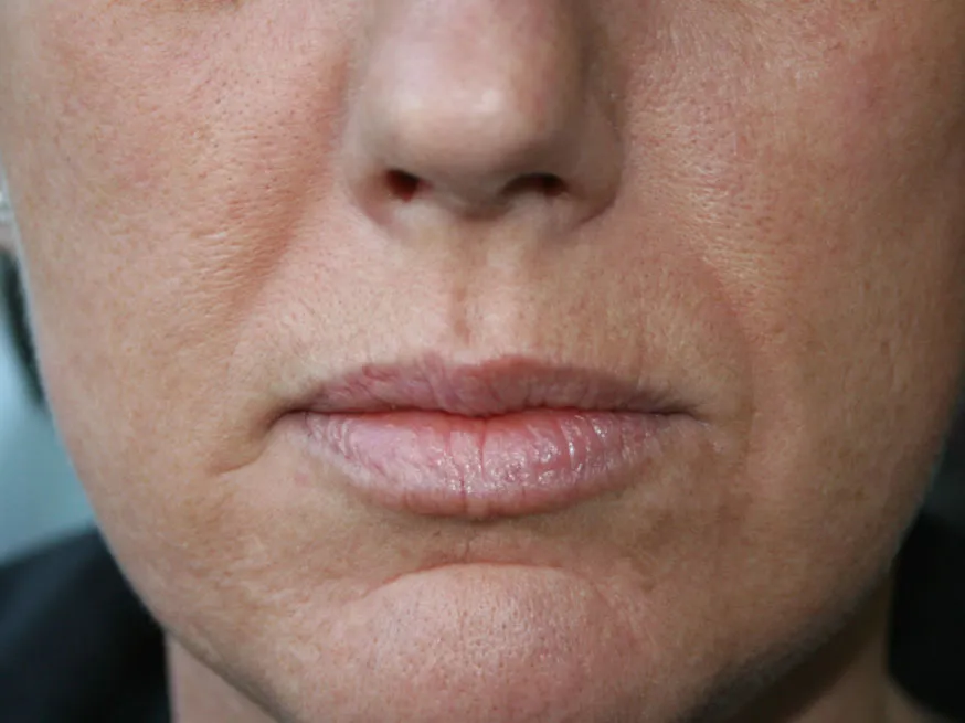 Skin Texture before genuine Endolift treatment — official Endolift gallery