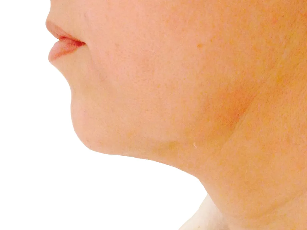 Under Chin after genuine Endolift treatment — official Endolift gallery
