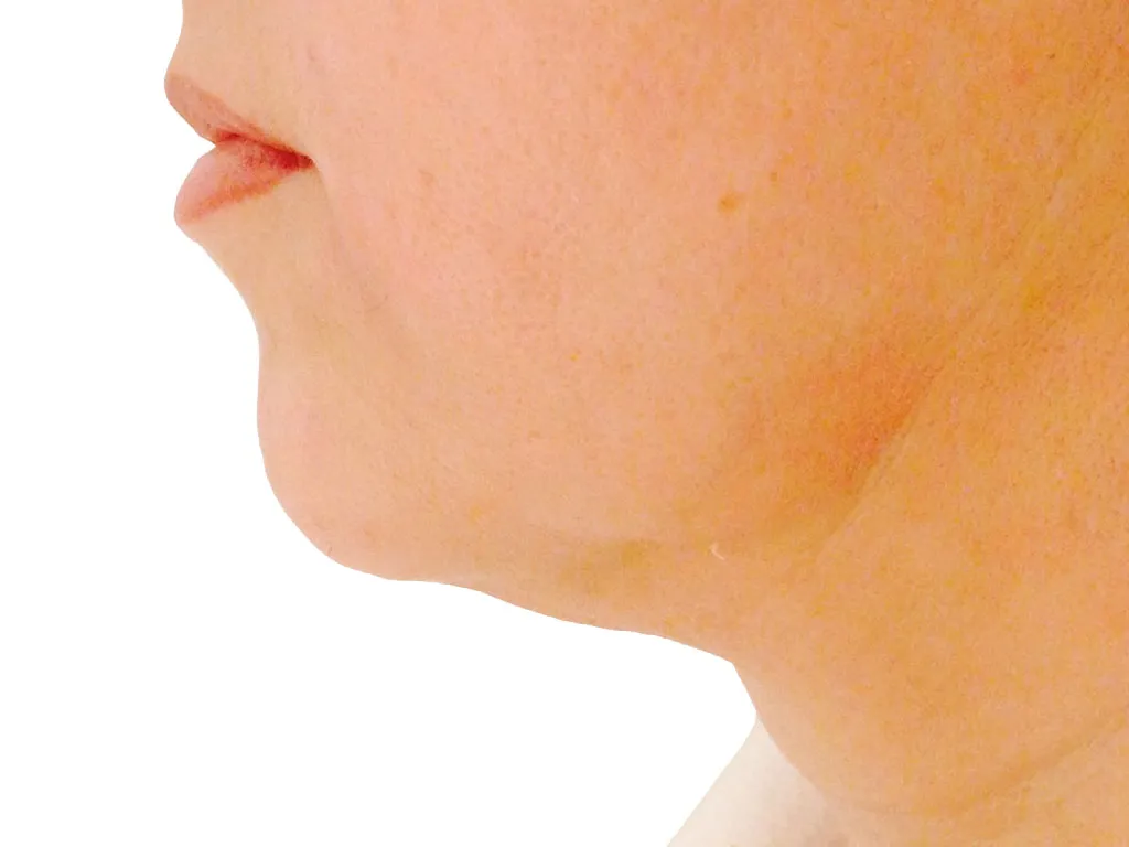 Under Chin before genuine Endolift treatment — official Endolift gallery