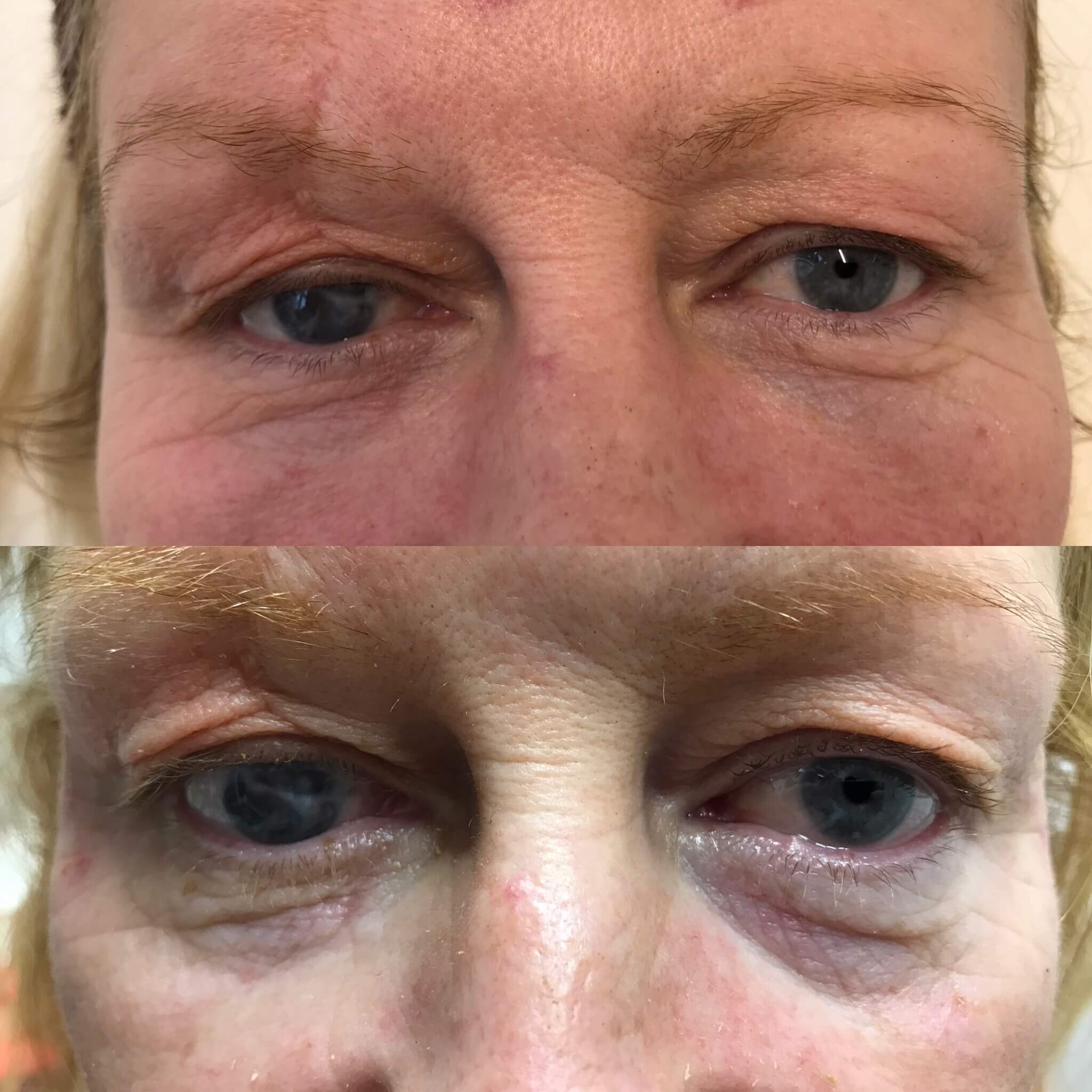 Eye Area Rejuvenation
