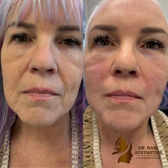 Full Face Rejuvenation