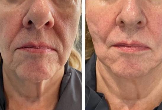 Lower Face & Jawline Lift
