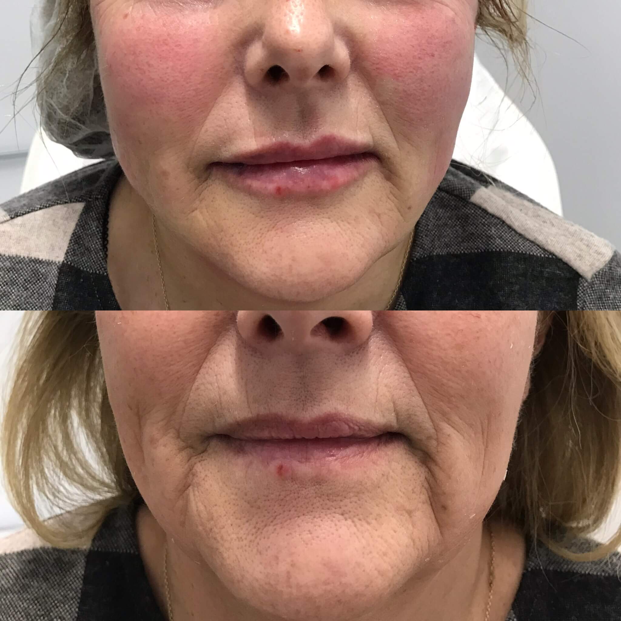 Lower Face & Mouth Area